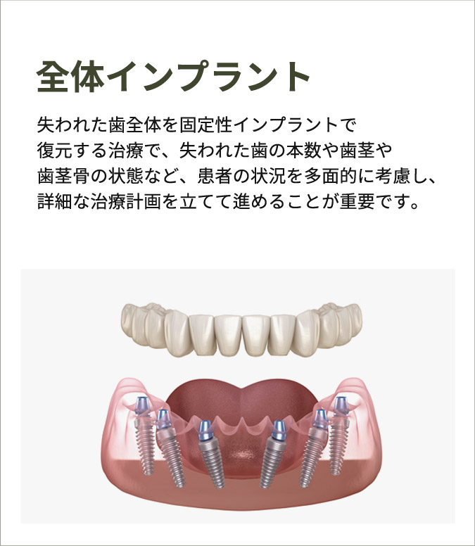 전체 임플란트