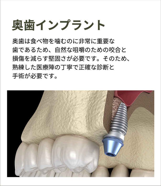 어금니 임플란트