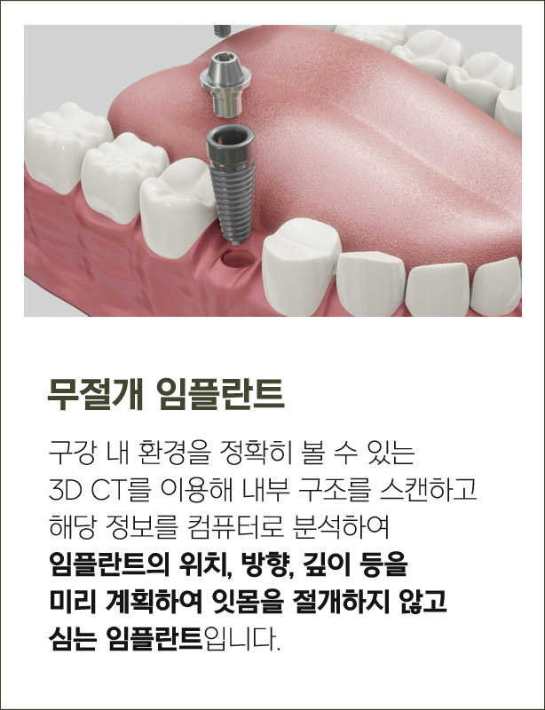 무절개 임플란트