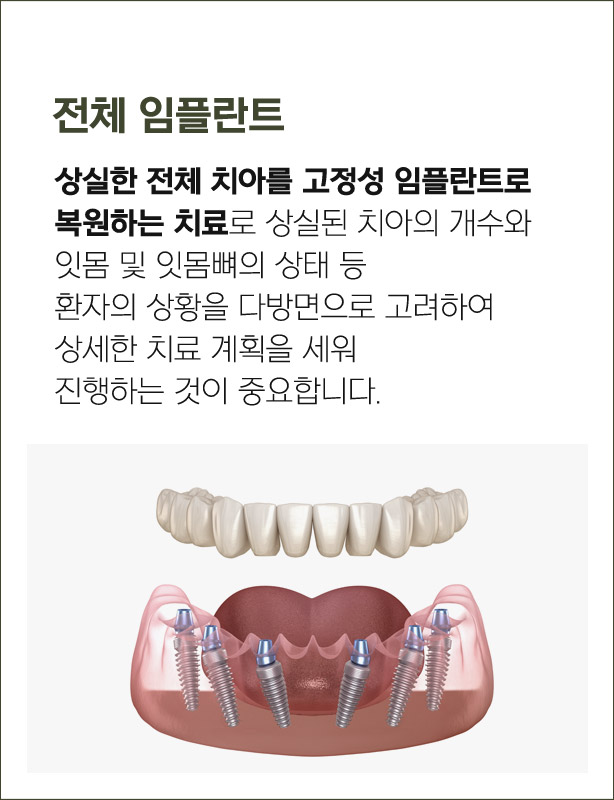 전체 임플란트