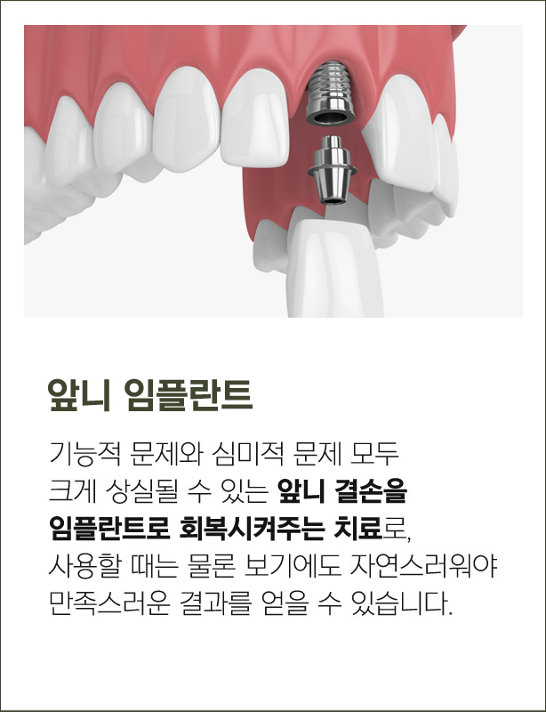 앞니 임플란트