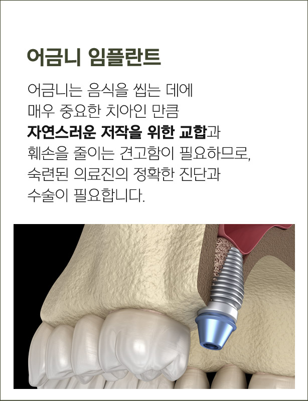 어금니 임플란트