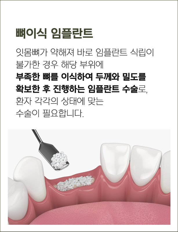 뼈이식 임플란트